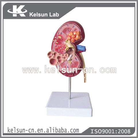 Kidney model (India) نموذج الكلية
