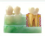 Disassembling Teeth Model- 4 parts